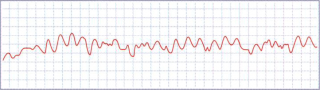 Sudden Cardiac Arrest VF Heart Rhythm